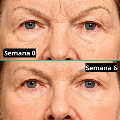 Cicatrix Vanish™ | Elimina Marcas De Acné, Cirugías y Quemaduras En 4 Semanas…!