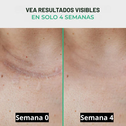 Cicatrix Vanish™ | Elimina Marcas De Acné, Cirugías y Quemaduras En 4 Semanas…!